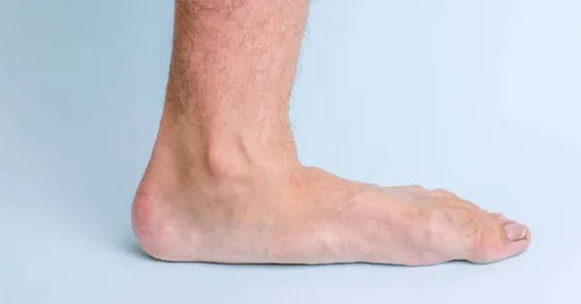 düz-tabanlık-nedir-3