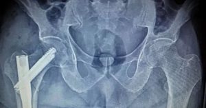 Kalça Kırığı Ameliyatı