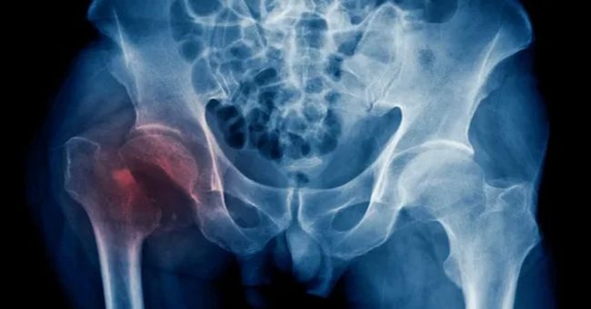 kalça- kırığı-ameliyatı-3