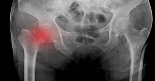 kalça-kırığı-tedavisi-3 Kalça Kırığı Tedavisi