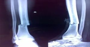 Kaval Kemiği Kırığı Ameliyatı