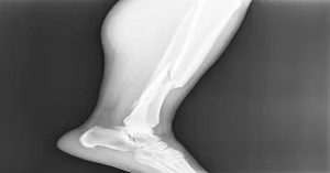 Kaval Kemiği Kırığı Tedavisi