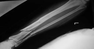 Kaval Kemiği Kırığı Tedavisi