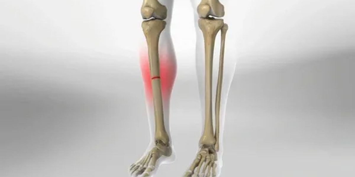 Kaval Kemiği Kırığı Tedavisi