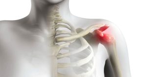 Omuz Sıkışması Sendromu Nedir