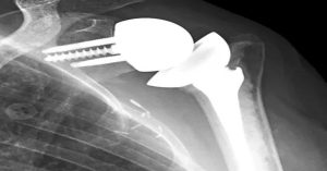 Ters Omuz Protezi Ameliyatı