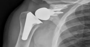 Ters Omuz Protezi Ameliyatı