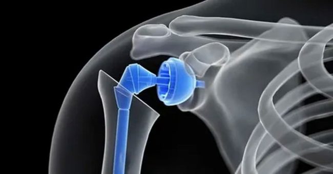 ters-omuz-protezi-ameliyatı-3