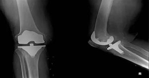 Unikondiler Diz Protezi Nedir?