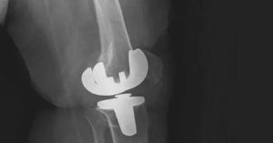 Unikondiler Diz Protezi Nedir?