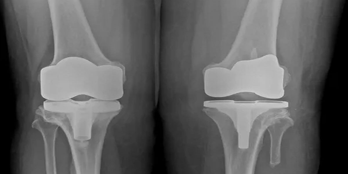 Unikondiler Diz Protezi Nedir?