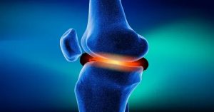 Menisküs Yırtığı Ameliyatı
