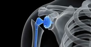 Ters Omuz Protezi Nedir? Ters Omuz Protezi Nedir?