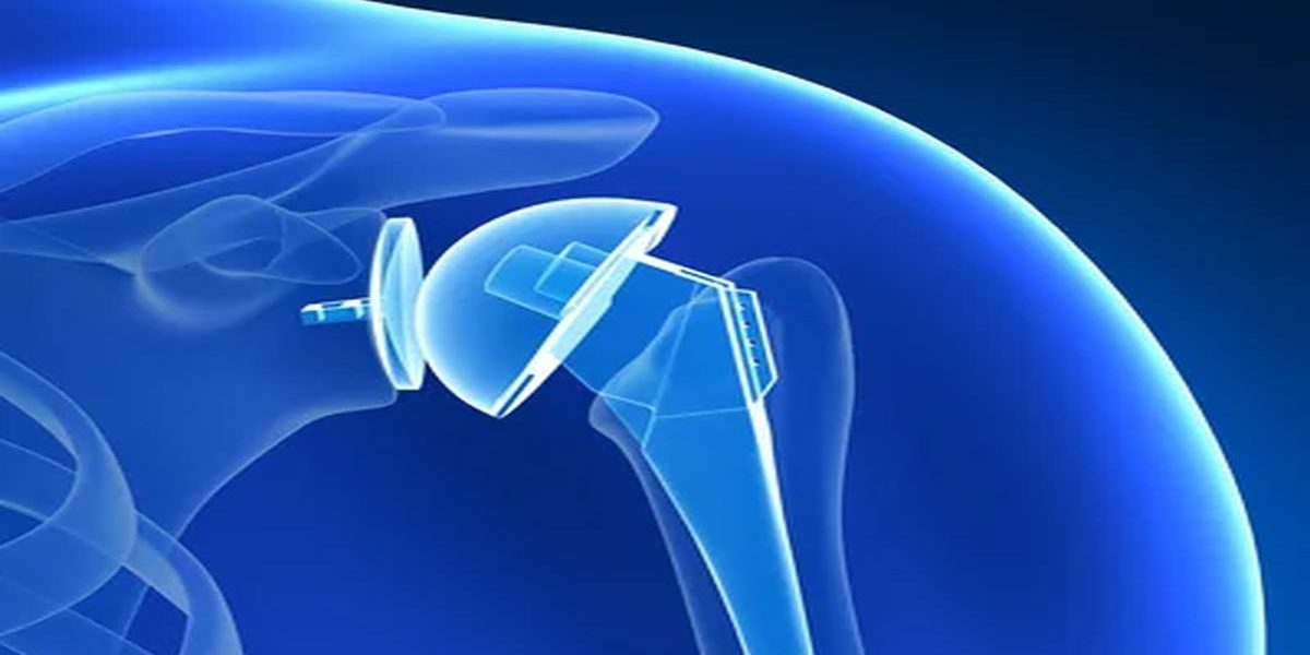 ters-omuz-2 Ters Omuz Protezi Nedir?