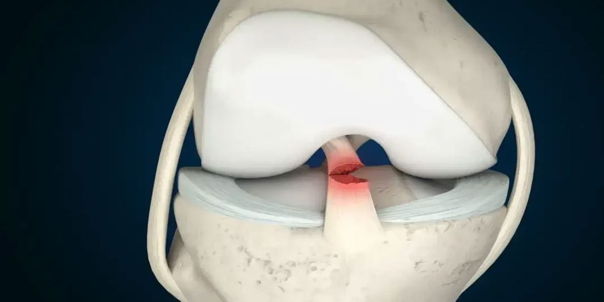 Ön Çapraz Bağ Yırtığı Belirtileri