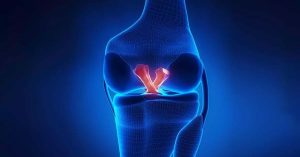 Ön Çapraz Bağ Yırtığı Belirtileri Ön Çapraz Bağ Yırtığı Belirtileri