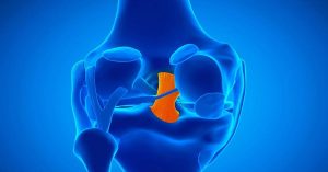 Ön Çapraz Bağ Yırtığı Belirtileri Ön Çapraz Bağ Yırtığı Belirtileri