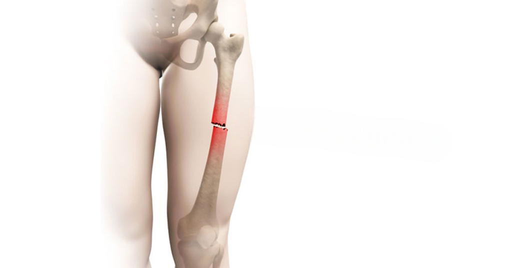 Uyluk Kemiği Kırığı Ameliyatı