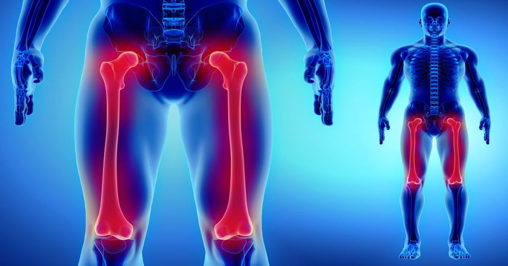 Uyluk Kemiği Kırığı Ameliyatı