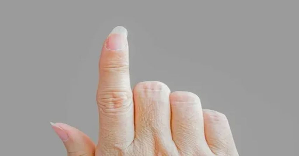 Çekiç Parmak Tedavisi