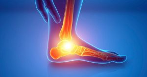 Düşük Ayak Sendromu Tedavisi