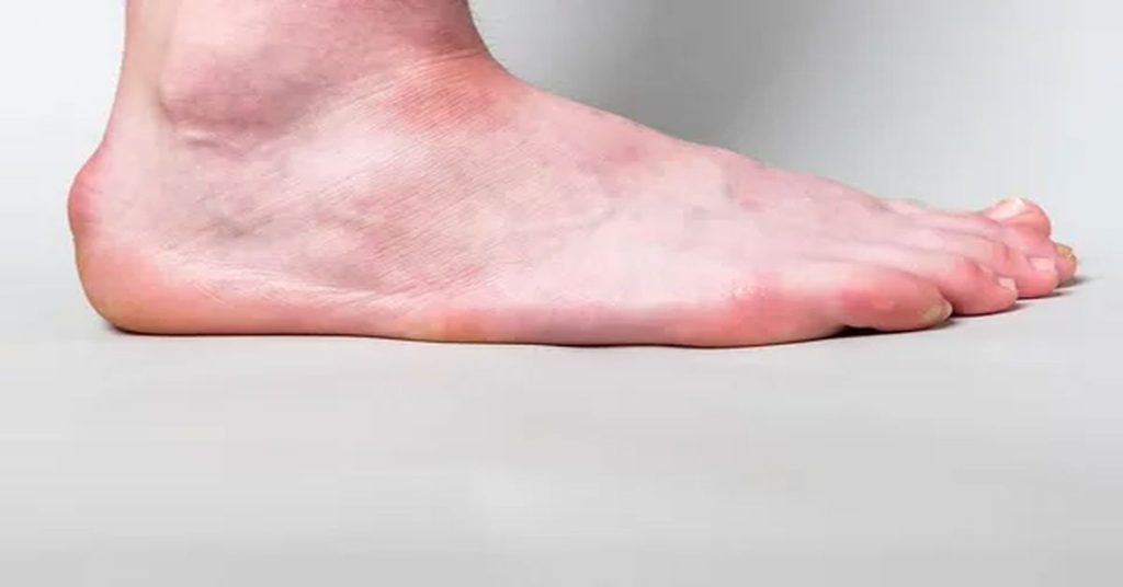 Haglund Hastalığı Tedavisi