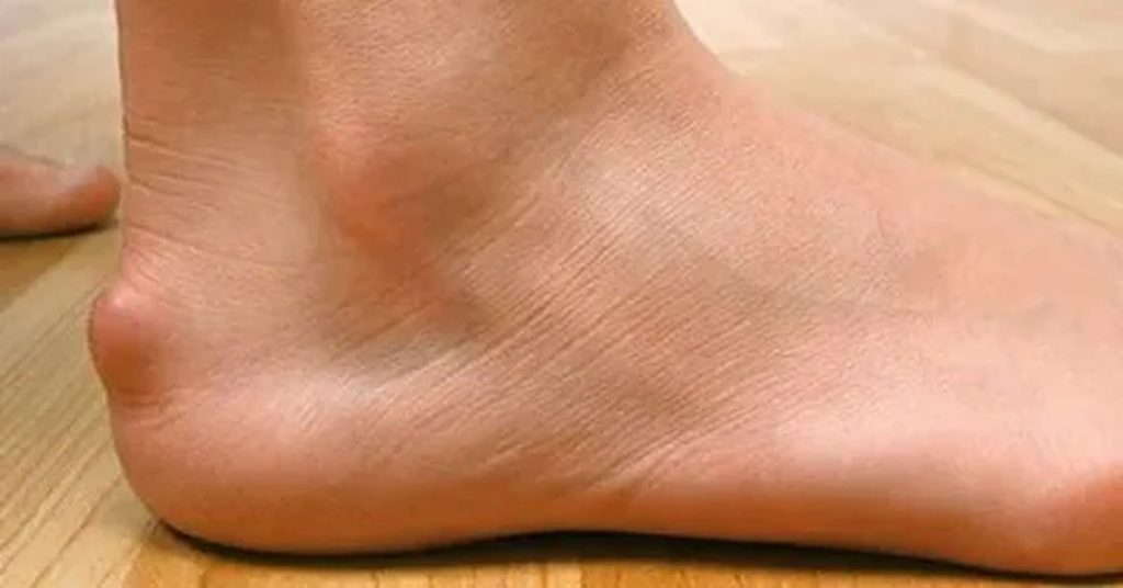 Haglund Hastalığı Tedavisi