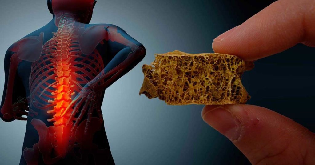 Kemik Erimesi Nedir?