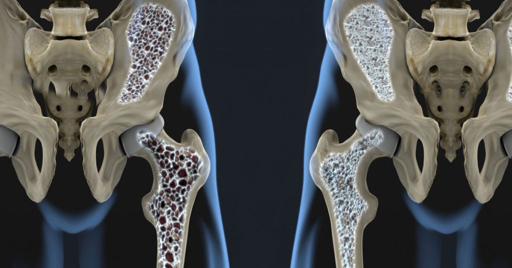 Kemik Erimesi Nedir?