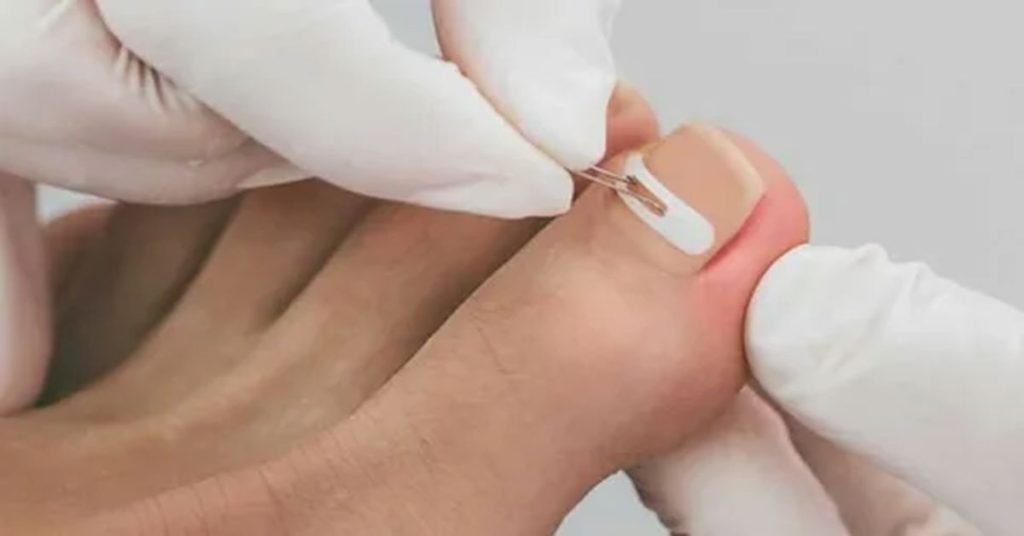 Tırnak Batması Tedavisi