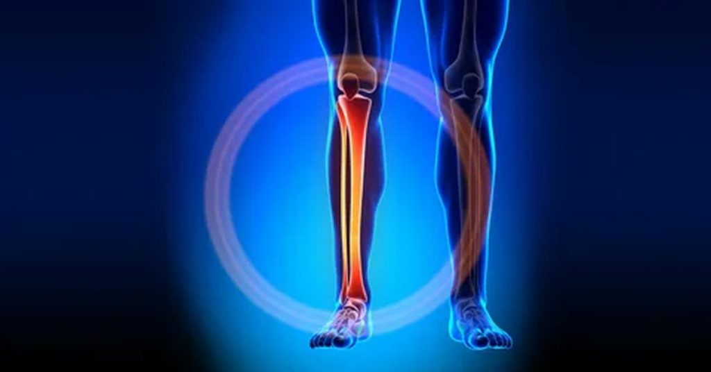 Kaval Kemiği Kırığı Tedavisi