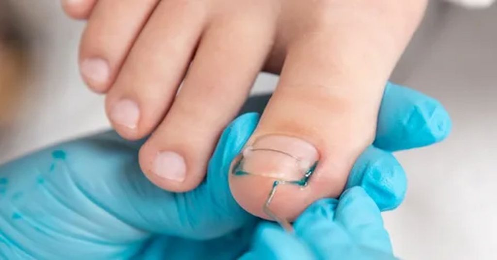 Tırnak Batması Ameliyatı